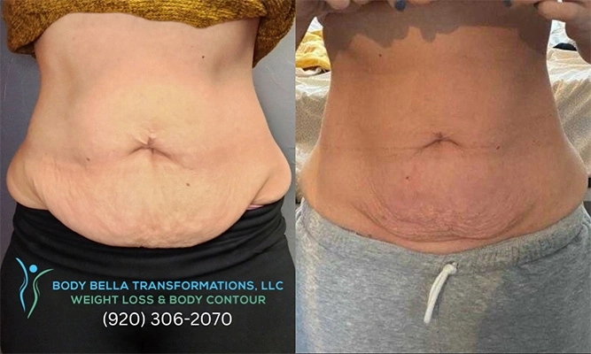 Weight Loss Green Bay WI Front Before And After